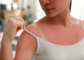 حروق الشمس على الجلد وطرق التخلص منها في المنزل